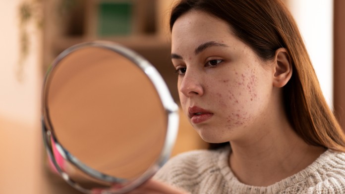 Akné. Ilustračná snímka. 