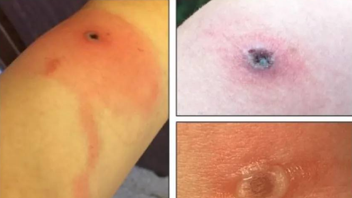 Nové vírusové ochorenie má prvú obeť. Všetko sa zrejme začalo škrabancom od mačky