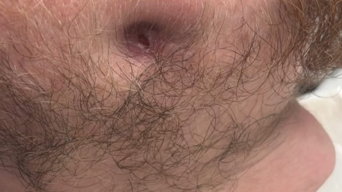 Strach zo zubárov ho stál veľa: Zanedbaný zubný kaz spôsobil mladému mužovi hotové peklo