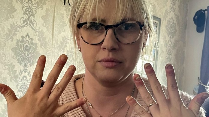 Žena roky nosila gélové nechty, teraz to horko ľutuje. Znetvorené prsty už takmer nedokáže ohnúť