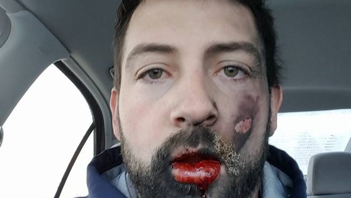 Andrew Hall po úraze.