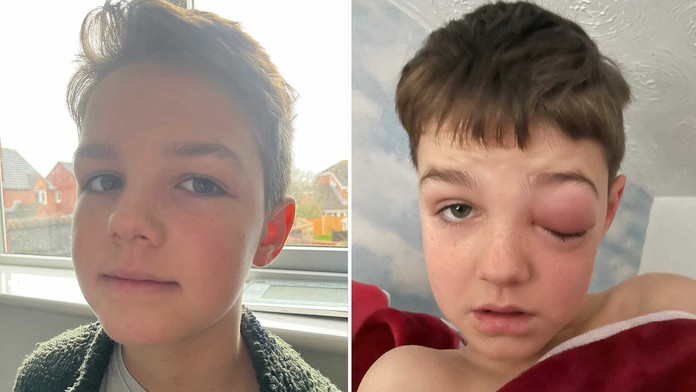 Malý Zac pred a počas nákazy.