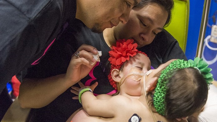 Siamské dievčatká prežili svoje oddelenie.