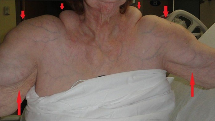 Žene narástli hrby.