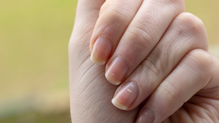 Biele škvrny či ryhy na nechtoch. Môžu poukazovať na nedostatok vitamínov, ale aj vážne ochorenia