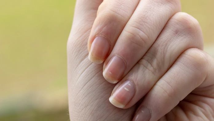 Biele škvrny či ryhy na nechtoch. Môžu poukazovať na nedostatok vitamínov, ale aj vážne ochorenia