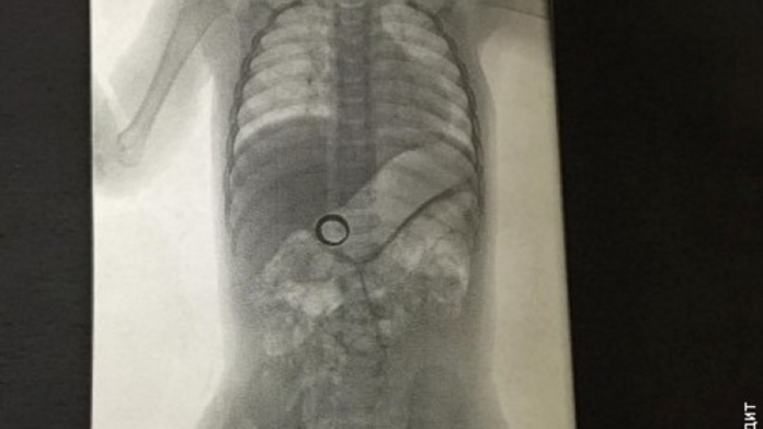 Röntgen žalúdka 14-mesačného chlapčeka