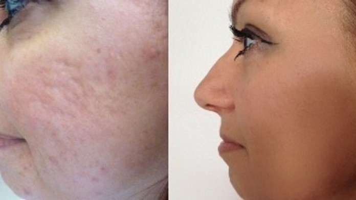 1_Poradňa -Problematika akné - Klientka pred a po ošetrení frakčným laserom.jpg