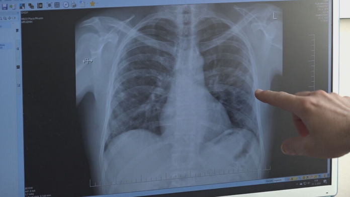 Seniorke pomohla zachrániť život umelá inteligencia. Nástroj jej odhalil nádor na pľúcach