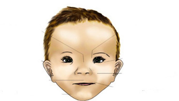 Fetal-Alcohol-Syndrome2.jpg
