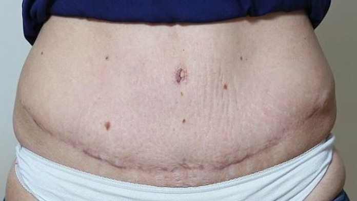 Michelle dnes trápi jazva cez celé brucho.