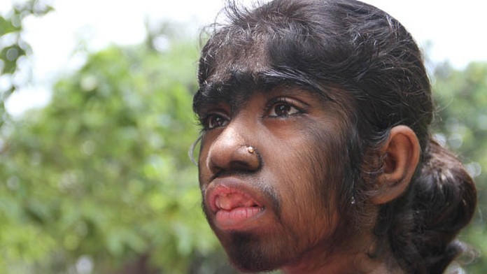 Bithi Aktar (12) z Bangladéša trpí "vlčím" syndrómom.