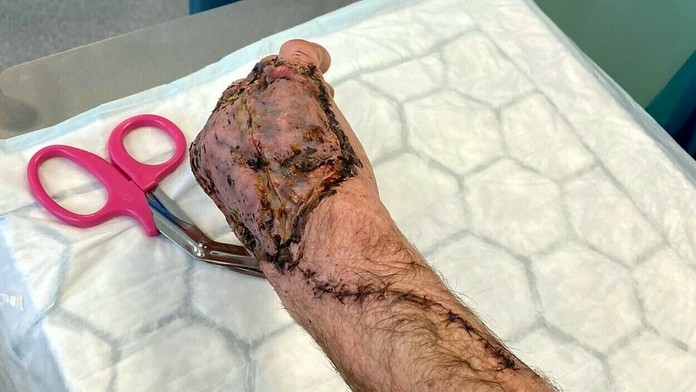 Nekrotizujúca fasciitída na ruke pacienta.