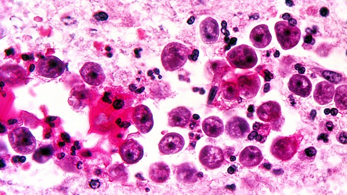 „Mozkožravá“ améba