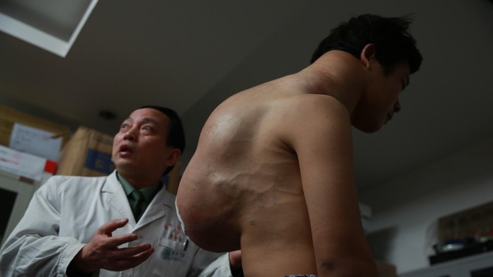 Číňan s 10 kg nádorom