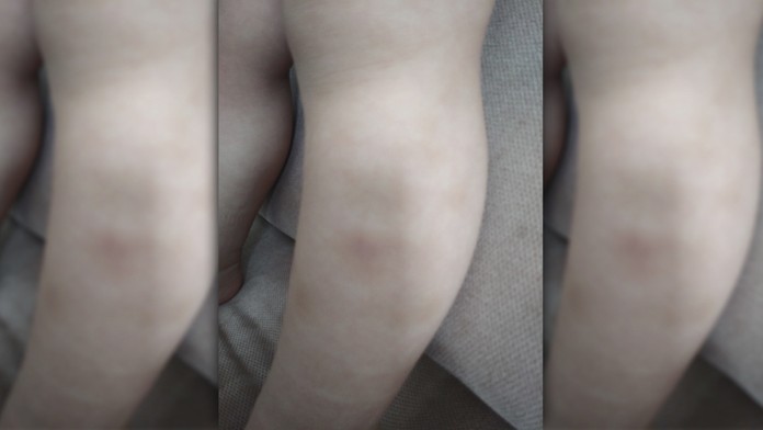 Dieťa mali držať tak silno, že mu ostali modriny