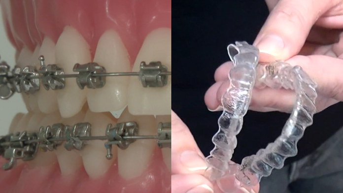 Mnoho dospelých dnes siaha po strojčeku na zuby. Zubní špecialisti radia, aký si vybrať