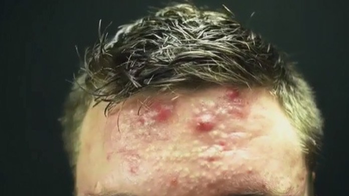 Kulturista sa zbavil akné.