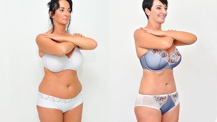 Klientka pred a po zákroku.