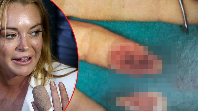 Lindsay Lohan zverejnila snímky, ako jej prišívali odseknutý prst