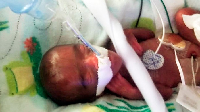 Najmenšie porodené dieťa na svete prežilo. Lekári mu dávali po pôrode hodinu
