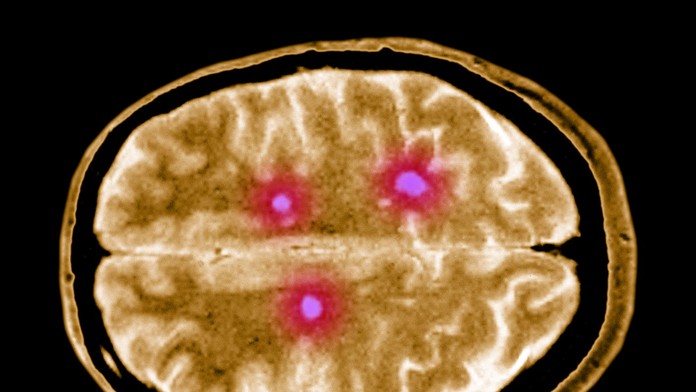 Vedci poukázali na nenápadný príznak sklerózy multiplex. Objavuje sa 15 rokov pred prepuknutím choroby