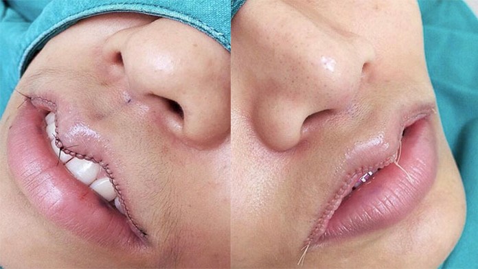 Zákrok vyzerá bolestivo.