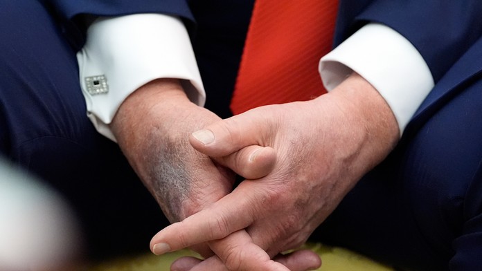 Obavy o zdravotný stav Trumpa: Prezident sa pravidelne objavuje s veľkými modrinami. Biely dom má odpoveď