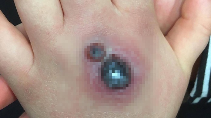 Dievčatko pohrýzol jedovatý pavúk.