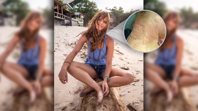 Mladá Britka mala alergiu na prácu