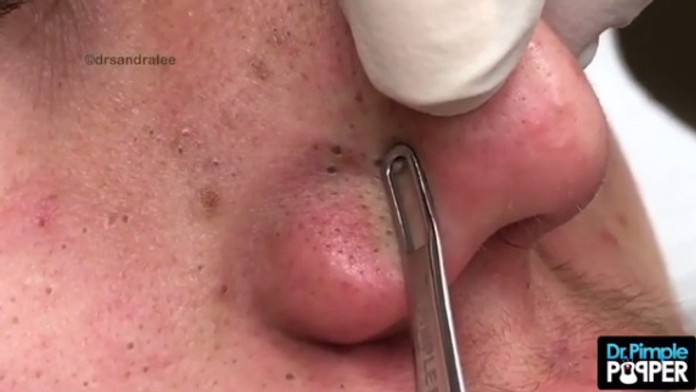 Videá vytláčania vyrážok sledujú milóny ľudí. Relaxujú pri tom