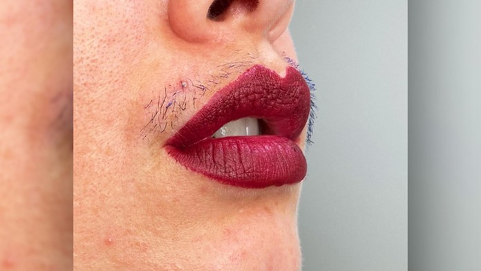 Chlpy na tvári Joanny Kenny.