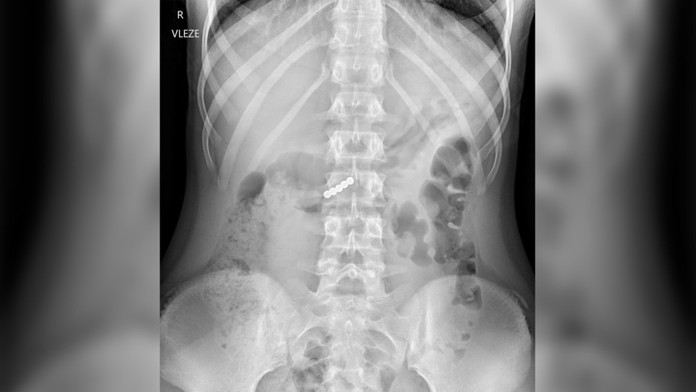 Výzva na sociálnej sieti dostala deti do nemocnice: Prehltli magnety, teraz bojujú o život