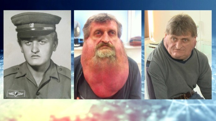 Štefan Zoleík žil s nádorom.