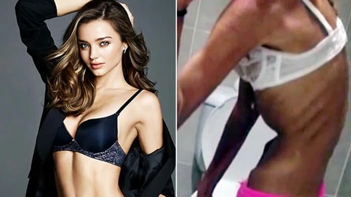 anorexia.jpg