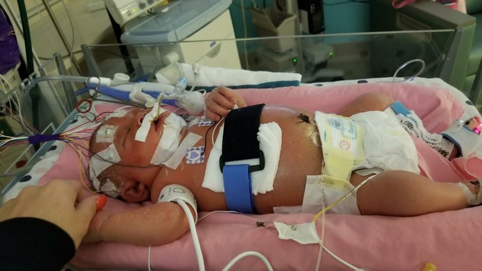 Šesťdňové bábätko skončilo po bozku v nemocnici. Zatiaľ neúspešne bojuje o život