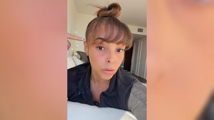 Po transplantácii vlasov sa u nej objavil prekvapivý problém. 