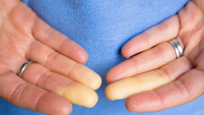 Raynaudovo ochorenie