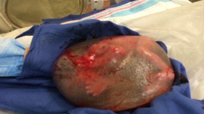 Dieťa sa narodilo v plodovom vaku.