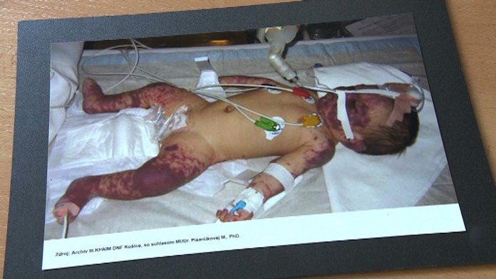 Stále viac podceňujeme zmysel očkovania.