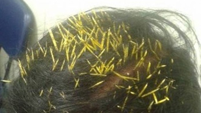 Dikobraz pristál žene na hlave