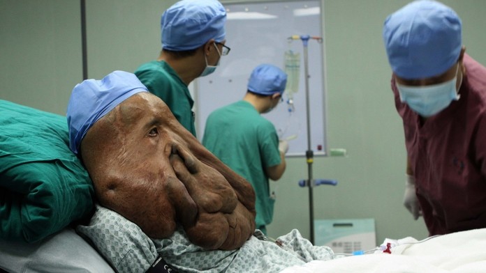 Číňanovi odstránili obrovský nádor