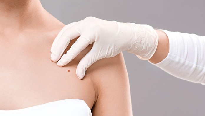 Znamienko, kožné vyšetrenie, rakovina (ilustračná snímka)