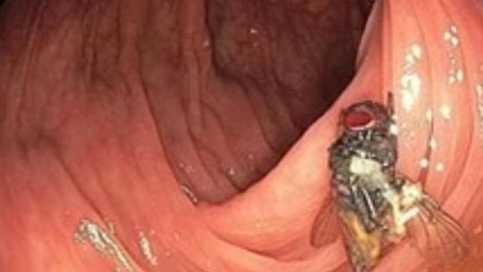 Nečakaný objav počas kolonoskopie: Do kamery zavedenej do čreva sa pozerala živá mucha