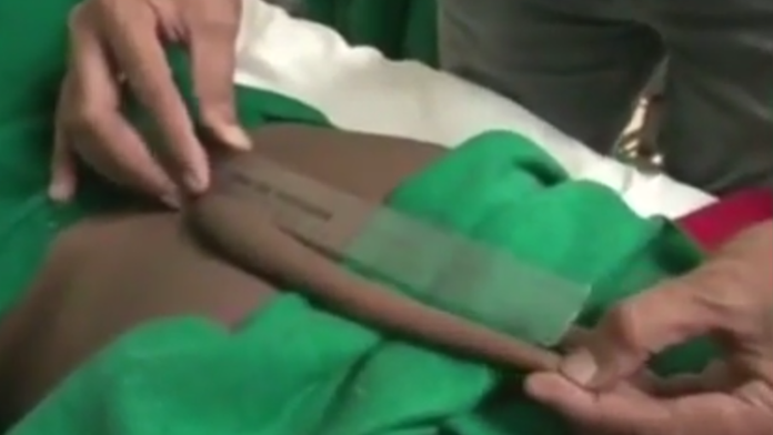 Je to pravdepodobne najdlhší zaznamenaný ľudský chvost.