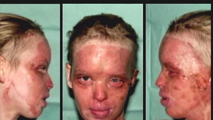 Katie Piper po útoku kyselinou.