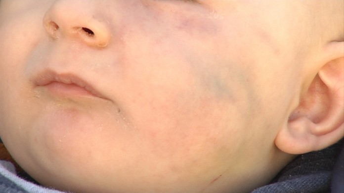 Adamkova doráňaná tvárička.