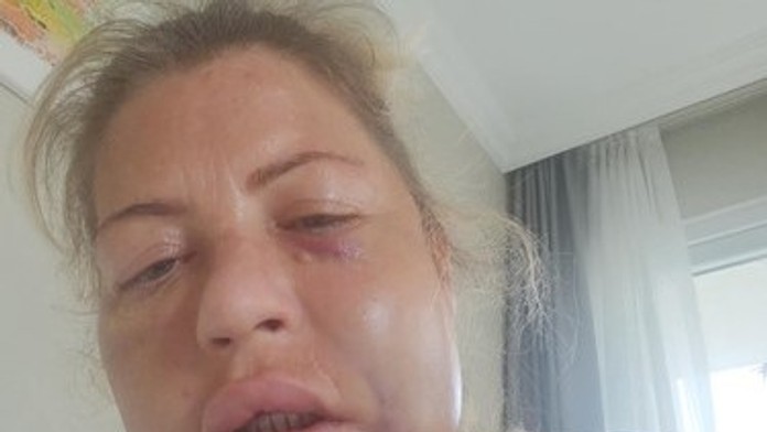 Vylepšenie úsmevu sa zmenilo na nočnú moru. Žena varuje pred lacnými zákrokmi v Turecku