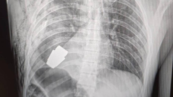 Chirurgovia odstránili z hrude vojaka nevybuchnutý granát.