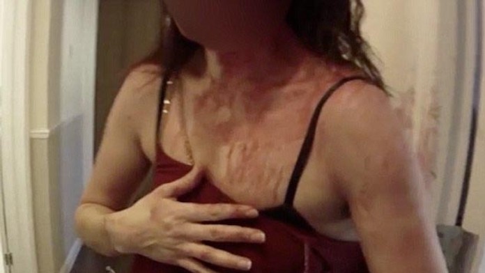 Obeť domáceho násilia.